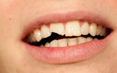 What should I do if I have a dental emergency, like a chipped or knocked-out tooth?