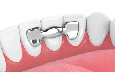 What are the options for replacing missing teeth (implants, bridges, dentures), and which is best for me?