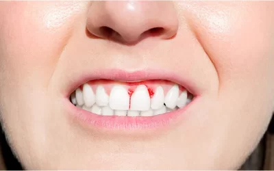 Are bleeding gums a sign of something serious, like gum disease?
