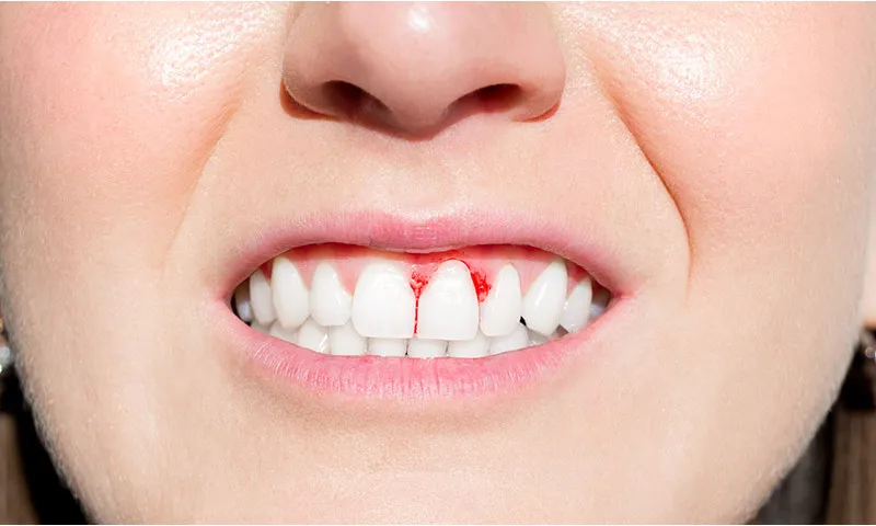 Are bleeding gums a sign of something serious, like gum disease?