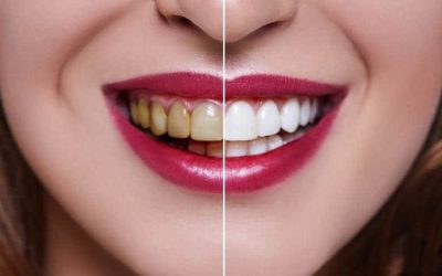 Is teeth whitening safe, and how long do the results typically last?