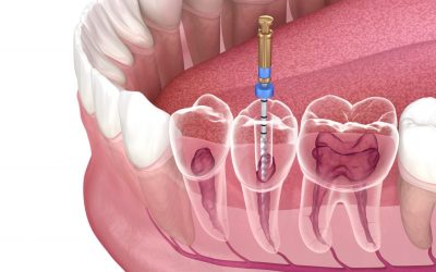 Does root canal treatment hurt, and what can I expect during the procedure?