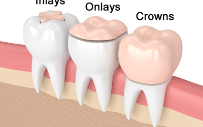 What’s the difference between a dental filling, inlay, and crown?